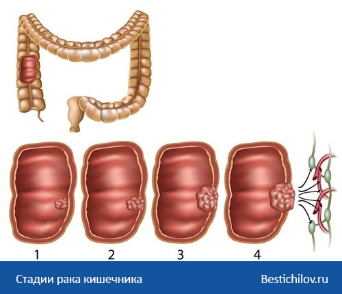 рак кишечника